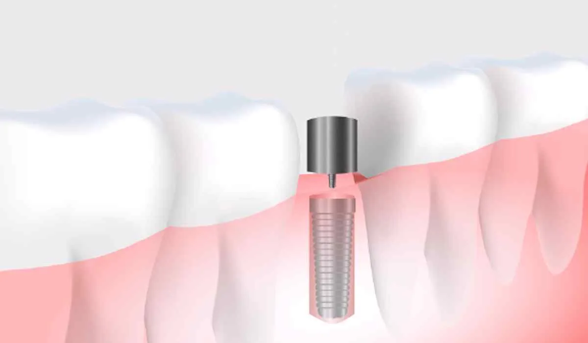 tab_image_01 https://smartdentalclinic.com.br/wp-content/uploads/2023/05/tab_image_01.jpg