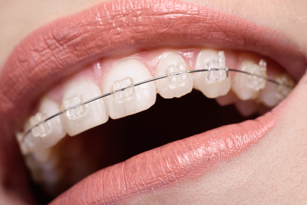 macro shot on woman mouth with braces on her teeth, low angle view, big smile, dentist concept.